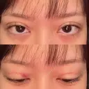 二重埋没 湘南美容クリニック 博多院 DAY 1 サムネイル用