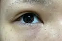 二重埋没 東京皮膚科・形成外科 (銀座いけだクリニック) DAY 29 サムネイル用