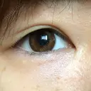 二重埋没 東京皮膚科・形成外科 (銀座いけだクリニック) DAY 39 サムネイル用