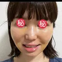 糸リフト / 脂肪吸引（顔） / メーラーファット除去 BLINC CLINIC （ブリンク クリニック） DAY 5 サムネイル用