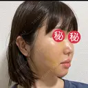 糸リフト / 脂肪吸引（顔） / メーラーファット除去 BLINC CLINIC （ブリンク クリニック） DAY 5 サムネイル用