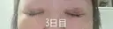 目元修正 / 自然癒着法 LUHO（ルホ）美容外科 DAY 3 サムネイル用