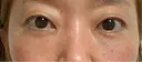 クマ治療 / 下まぶたたるみ取り / 下まぶたの脂肪取り / 脂肪注入（目の下） 湘南美容クリニック 千葉センシティ院 DAY 35 サムネイル用