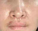 クマ治療 / 人中短縮 くさのたろうクリニック DAY 7 サムネイル用