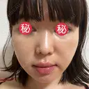 糸リフト / 脂肪吸引（顔） / メーラーファット除去 BLINC CLINIC （ブリンク クリニック） DAY 6 サムネイル用