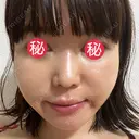 糸リフト / 脂肪吸引（顔） / メーラーファット除去 BLINC CLINIC （ブリンク クリニック） DAY 6 サムネイル用