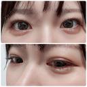 ヒアルロン酸注入（涙袋） NARU Beauty Clinic 【ナルクリ】 AFTER サムネイル用