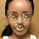 切開リフト 東京エビスクリニック AFTER サムネイル用