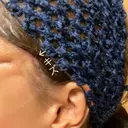 切開リフト 東京エビスクリニック DAY 10 サムネイル用