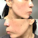 シミ取りレーザー / ピコレーザートーニング（美白・肝斑） PRISM Beauty Clinic 町田院 DAY 1 サムネイル用