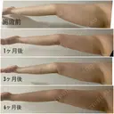 脂肪吸引（二の腕） / 脂肪吸引（肩） Mods Clinic（モッズクリニック） 大阪院 AFTER サムネイル用