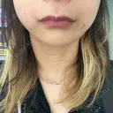 脂肪溶解注射（顔） TCB東京中央美容外科 横浜院 DAY 0 サムネイル用