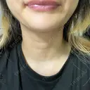 脂肪溶解注射（顔） TCB東京中央美容外科 横浜院 AFTER サムネイル用