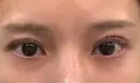 二重切開 WOM CLINIC GINZA （ワム クリニック ギンザ） AFTER サムネイル用