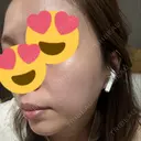 ピコレーザートーニング（美白・肝斑） / ピコフラクショナルレーザー（毛穴・ニキビ跡） BISIN GINZA CLINIC DAY 1 サムネイル用