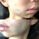 糸リフト / ジョールファット除去 吉祥寺アイビークリニック DAY 0 サムネイル用