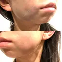 糸リフト / ジョールファット除去 吉祥寺アイビークリニック DAY 1 サムネイル用