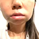 糸リフト / ジョールファット除去 吉祥寺アイビークリニック DAY 1 サムネイル用