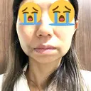 糸リフト / ジョールファット除去 吉祥寺アイビークリニック DAY 2 サムネイル用