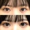 二重埋没 / 目頭切開 東京シンデレラ美容外科 池袋院 DAY 31 サムネイル用