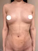 脂肪吸引（二の腕） / 脂肪吸引（お腹） / 豊胸（脂肪注入） / ワキ汗治療（切開） / その他 ICON CLINIC DAY 36 サムネイル用