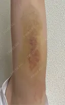 脂肪冷却（二の腕） LE CLINIC DAY 5 サムネイル用