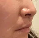 クマ治療 / 人中短縮 くさのたろうクリニック DAY 9 サムネイル用