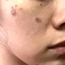 白玉点滴・注射 / シミ取りレーザー S-Laboクリニック 渋谷院 DAY 5 サムネイル用