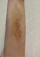 脂肪冷却（二の腕） LE CLINIC DAY 6 サムネイル用