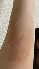 脂肪冷却（二の腕） LE CLINIC DAY 6 サムネイル用