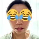 糸リフト / ジョールファット除去 吉祥寺アイビークリニック AFTER サムネイル用