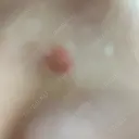 ほくろ・いぼ除去レーザー（肌） 美容皮膚科エルムクリニック 大阪院 DAY 6 サムネイル用