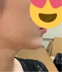 ヒアルロン酸注入（あご） Tokyo Tensei Clinic 銀座院 DAY 8 サムネイル用