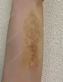 脂肪冷却（二の腕） LE CLINIC DAY 7 サムネイル用