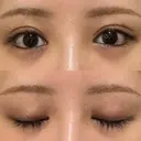 二重埋没 / 目尻切開 / 下まぶたの脂肪取り / タレ目形成・グラマラスライン（埋没） / 美容点滴・美容注射（美肌） LOUIS CLINIC 二子玉川院【ルイクリニック】 DAY 20 サムネイル用