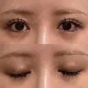 二重埋没 / 目尻切開 / 下まぶたの脂肪取り / タレ目形成・グラマラスライン（埋没） / 美容点滴・美容注射（美肌） LOUIS CLINIC 二子玉川院【ルイクリニック】 DAY 21 サムネイル用