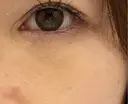 クマ治療 みずほクリニック DAY 3 サムネイル用