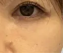 クマ治療 みずほクリニック DAY 8 サムネイル用