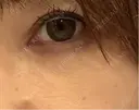 クマ治療 みずほクリニック DAY 17 サムネイル用