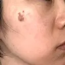 白玉点滴・注射 / シミ取りレーザー S-Laboクリニック 渋谷院 DAY 8 サムネイル用