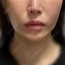 糸リフト / バッカルファット除去 / 脂肪吸引（顔） / ジョールファット除去 BLINC CLINIC （ブリンク クリニック） DAY 49 サムネイル用