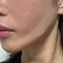 糸リフト / バッカルファット除去 / 脂肪吸引（顔） / ジョールファット除去 BLINC CLINIC （ブリンク クリニック） DAY 49 サムネイル用