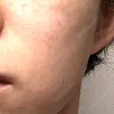 白玉点滴・注射 / シミ取りレーザー S-Laboクリニック 渋谷院 DAY 9 サムネイル用
