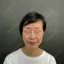 糸リフト / クマ治療 / ヒアルロン酸注入（目の下） ネビュラクリニック 京都院 AFTER サムネイル用