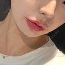 ヒアルロン酸注入（唇） Code Beauty Clinic 名古屋院 AFTER サムネイル用