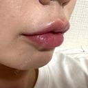 ヒアルロン酸注入（唇） Code Beauty Clinic 名古屋院 DAY 0 サムネイル用