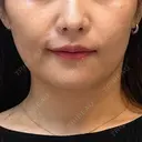 その他（輪郭） 表参道メディカルクリニック 銀座院 AFTER サムネイル用