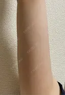 脂肪冷却（二の腕） LE CLINIC DAY 8 サムネイル用