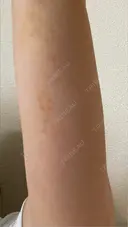 脂肪冷却（二の腕） LE CLINIC AFTER サムネイル用