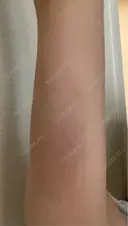 脂肪冷却（二の腕） LE CLINIC DAY 11 サムネイル用